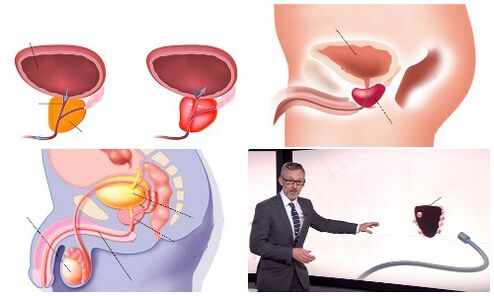 gesunde und erkrankte Prostata