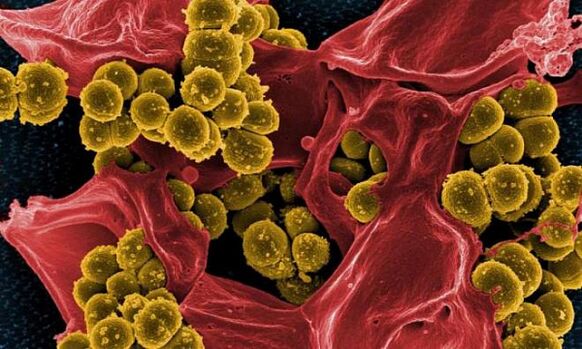 Staphylococcus aureus als Ursache einer bakteriellen Prostatitis